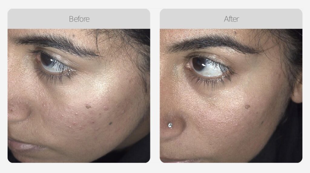 Medilux LED Medical Grade Light Therapy Sensational Skin Care